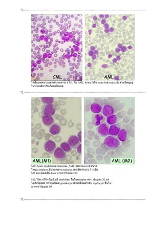 71.------------------------------------------------------------------------------------------------------------------
ใหสังเกตความแตกตางระหวาง CML กับ AML จะพบวาใน acute leukemia cells สวนใหญอยู
ในระยะเดียวกันเกือบทั้งหมด
72.------------------------------------------------------------------------------------------------------------------
M1: Acute myeloblastic leukemia (AML) พบ blast cell ขนาด
ใหญcytoplasm มีปานกลาง nucleolus เดนชัดจํานวน 3-5 อัน
M1 พบเซลลเปน blast มากกวารอยละ 90
M2: ใหการวินิจฉัยเมื่อมีmyeloblast ในไขกระดูกมากกวารอยละ 20 แต
ไมถึงรอยละ 90 พบเซลลgranulocyte ตัวแกตั้งแตระดับ myelocyte ขึ้นไป
มากกวารอยละ 10
73.------------------------------------------------------------------------------------------------------------------
 