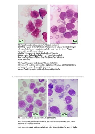 M3: Acute Promyelocytic Leukemia (APL) ใหสังเกต blast cell มี
ขนาดใหญมีgranule เม็ดหยาบใหญสีแดงจํานวนมาก acute leukemia ชนิดนี้ผูปวยมีปญหา
เลือดออกผิดปกติมากกวา acute leukemia ชนิดอื่น และอาจพบ DIC รวมดวยไดบอย
ประมาณ 2/3 ของผูปวย acute leukemia
ชนิดนี้มีภาวะ pancytopenia เมื่อแรกวินิจฉัยผูปวย APL ทุกราย
ตองตรวจพบโครโมโซมผิดปกติชนิด t(15,17) Acute leukemia ชนิดนี้
มีพยากรณโรคดีที่สุด หากไดรับการรักษาที่ถูกตองจะมีโอกาสโรคสงบ
ระยะยาวมากที่สุด
M4: Acute Myelomonocytic Leukemia (AMMoL) ใหสังเกตวา
พบ blast cell ทั้ง myeloblast และ monoblast อยูปนกันโดยทิ่blast cell ชนิดที่พบนอยกวาพบ
เกินรอยละ 20 หากพบวามีeosinophils เพิ่มขึ้นดวย
และตรวจโครโมโซมพบ ivs(16) ผูปวยมักมีพยากรณโรคดีเชนกัน
74.------------------------------------------------------------------------------------------------------------------
M5 : Acute Monoblastic leukemia (AMoL) มี2 ชนิดยอยคือ
M5a : Monoblast มีลักษณะเปนตัวออนมาก ใหสังเกต chromatin pattern ของ blast cell จะ
ละเอียดมาก และเห็น nucleolus ชัด
M5b: Monoblast คอนขางมีลักษณะเปนตัวแกมากขึ้น ลักษณะใกลเคียงกับ monocyte ดังนั้น
 