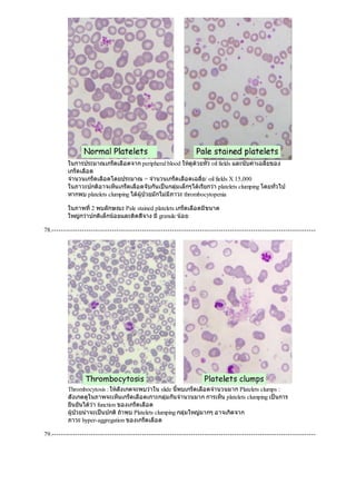 ในการประมาณเกร็ดเลือดจาก peripheral blood ใหดูดวยหัว oil fields และนับคาเฉลี่ยของ
เกร็ดเลือด
จํานวนเกร็ดเลือดโดยประมาณ = จํานวนเกร็ดเลือดเฉลี่ย/ oil fields X 15,000
ในภาวะปกติอาจเห็นเกร็ดเลือดจับกันเปนกลุมเล็กๆไดเรียกวา platelets clumping โดยทั่วไป
หากพบ platelets clumping ไดผูปวยมักไมมีภาวะ thrombocytopenia
ในภาพที่2 พบลักษณะ Pale stained platelets เกร็ดเลือดมีขนาด
ใหญกวาปกติเล็กนอยและติดสีจาง มีgranule นอย
78.------------------------------------------------------------------------------------------------------------------
Thrombocytosis : ใหสังเกตจะพบวาใน slide นี้พบเกร็ดเลือดจํานวนมาก Platelets clumps :
สังเกตดูในภาพจะเห็นเกร็ดเลือดเกาะกลุมกันจํานวนมาก การเห็น platelets clumping เปนการ
ยืนยันไดวา function ของเกร็ดเลือด
ผูปวยนาจะเปนปกติถาพบ Platelets clumping กลุมใหญมากๆ อาจเกิดจาก
ภาวะ hyper-aggregation ของเกร็ดเลือด
79.------------------------------------------------------------------------------------------------------------------
 