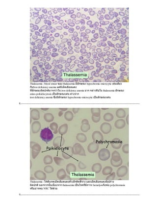 Thalassemia : blood smear ของ thalassemia มีลักษณะ hypochromic-microcytic เชนเดียว
กับIron deficiency anemia แตมีเม็ดเลือดแดง
ที่ลักษณะผิดปกติมากกวาใน iron deficiency anemia มาก กลาวคือใน thalassemia ลักษณะ
aniso-poikielocytosis เปนลักษณะเดน ตางจาก
iron deficiency anemia ซึ่งมีลักษณะ hypochromic-microcytic เปนลักษณะเดน
8.--------------------------------------------------------------------------------------------------------------------
Thalassemia : ใหสังเกตเม็ดเลือดแดงตัวเล็กติดสีจาง และเม็ดเลือดแดงมีรูปราง
ผิดปกตินอกจากนั้นเนื่องจาก thalassemia เปนโรคที่มีภาวะ hemolysisจึงพบ polychromasia
หรืออาจพบ NRC ไดดวย
9.--------------------------------------------------------------------------------------------------------------------
 