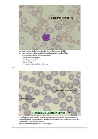 Basophilic stippling : ที่เห็นเปนจุดเล็กๆสีนํ้าเงินในเม็ดเลือดแดง สิ่งนี้คือ
เศษชิ้นสวนของ RNA ที่หลงเหลืออยูในเม็ดเลือดแดง ลักษณะนี้พบไดใน
- blood smear ของผูปวย thalassemia บางราย
- Hemoglobin Constant Spring
- Myelodysplastic syndrome
- Lead poisoning
- 5’ Pyrimidine oxidase inhibitor deficeincy
10.------------------------------------------------------------------------------------------------------------------
ในรูปเปน Blood smear ของผูปวย Homozygous Hemoglobin Constant Spring เม็ดเลือดแดง
บางเซลลในภาพมีcentral pallor ลักษณะคลายปากเรียกวา stomatocyte ลักษณะเชนนี้ถาพบ
ในเซลลเม็ดเลือดแดงสวนมากมักเปน
ความผิดปกติทางพันธุกรรมเรียกวา stomatocytosis
11.------------------------------------------------------------------------------------------------------------------
 