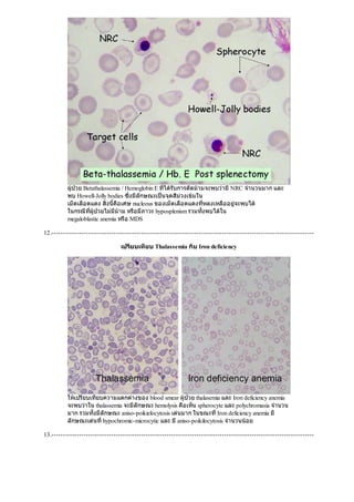 ผูปวย Betathalassemia / Hemoglobin E ที่ไดรับการตัดมามจะพบวามีNRC จํานวนมาก และ
พบ Howell-Jolly bodies ซึ่งมีลักษณะเปนจุดสีมวงเขมใน
เม็ดเลือดแดง สิ่งนี้คือเศษ nucleous ของเม็ดเลือดแดงที่หลงเหลืออยูจะพบได
ในกรณีที่ผูปวยไมมีมาม หรือมีภาวะ hyposplenism รวมทั้งพบไดใน
megaloblastic anemia หรือ MDS
12.------------------------------------------------------------------------------------------------------------------
เปรียบเทียบ Thalassemia กับ Iron deficiency
ใหเปรียบเทียบความแตกตางของ blood smear ผูปวย thalasemia และ Iron deficiency anemia
จะพบวาใน thalassemia จะมีลักษณะ hemolysis คือเห็น spherocyte และ polychromasia จํานวน
มาก รวมทั้งมีลักษณะ aniso-poikielocytosis เดนมาก ในขณะที่Iron deficiency anemia มี
ลักษณะเดนที่hypochromic-microcytic และ มีaniso-poikilocytosis จํานวนนอย
13.------------------------------------------------------------------------------------------------------------------
 