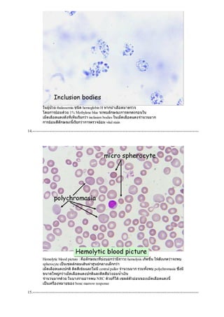 ในผูปวย thalassemia ชนิด hemoglobin H หากนําเลือดมาตรวจ
โดยการยอมดวย 1% Methylene blue จะพบลักษณะการตกตะกอนใน
เม็ดเลือดแดงดังที่เห็นเรียกวา inclusion bodies ในเม็ดเลือดแดงจํานวนมาก
การยอมสีลักษณะนี้เรียกวาการตรวจยอม vital stain
14.------------------------------------------------------------------------------------------------------------------
Hemolytic blood picture : คือลักษณะที่บงบอกวามีภาวะ hemolysis เกิดขึ้น ใหสังเกตวาจะพบ
spherocyte เปนเซลลกลมเสนผาศูนยกลางเล็กกวา
เม็ดเลือดแดงปกติติดสีเขมและไมมีcentral pallor จํานวนมาก รวมทั้งพบ polychromasia ซึ่งมี
ขนาดใหญกวาเม็ดเลือดแดงปกติและติดสีมวงอมนํ้าเงิน
จํานวนมากดวย ในบางรายอาจพบ NRC ดวยก็ไดเซลลตัวออนของเม็ดเลือดแดงนี้
เปนเครื่องหมายของ bone marrow response
15.------------------------------------------------------------------------------------------------------------------
 