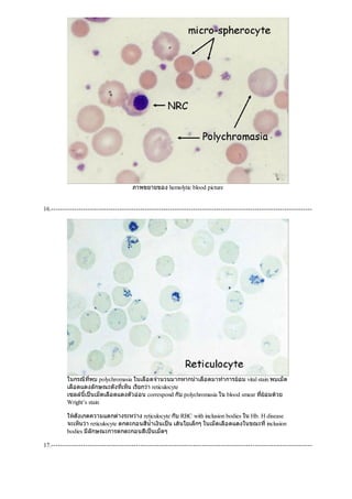 ภาพขยายของ hemolytic blood picture
16.------------------------------------------------------------------------------------------------------------------
ในกรณีที่พบ polychromasia ในเลือดจํานวนมากหากนําเลือดมาทําการยอม vital stain พบเม็ด
เลือดแดงลักษณะดังที่เห็น เรียกวา reticulocyte
เซลลนี้เปนเม็ดเลือดแดงตัวออน correspond กับ polychromasia ใน blood smear ที่ยอมดวย
Wright’s stain
ใหสังเกตความแตกตางระหวาง reticulocyte กับ RBC with inclusion bodies ใน Hb. H disease
จะเห็นวา reticulocyte ตกตะกอนสีนํ้าเงินเปน เสนใยเล็กๆ ในเม็ดเลือดแดงในขณะที่inclusion
bodies มีลักษณะการตกตะกอนสีเปนเม็ดๆ
17.------------------------------------------------------------------------------------------------------------------
 