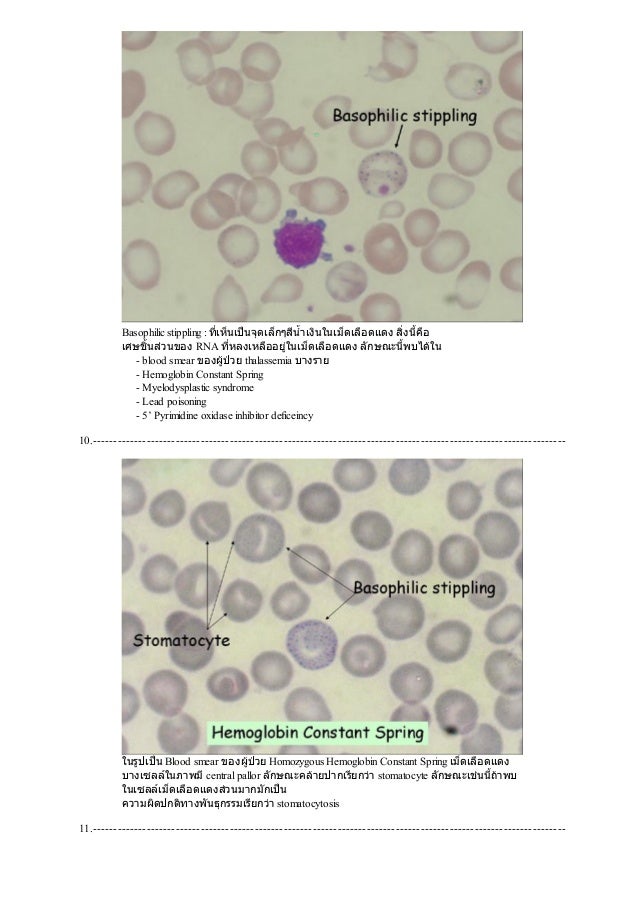 Peripheral blood smear