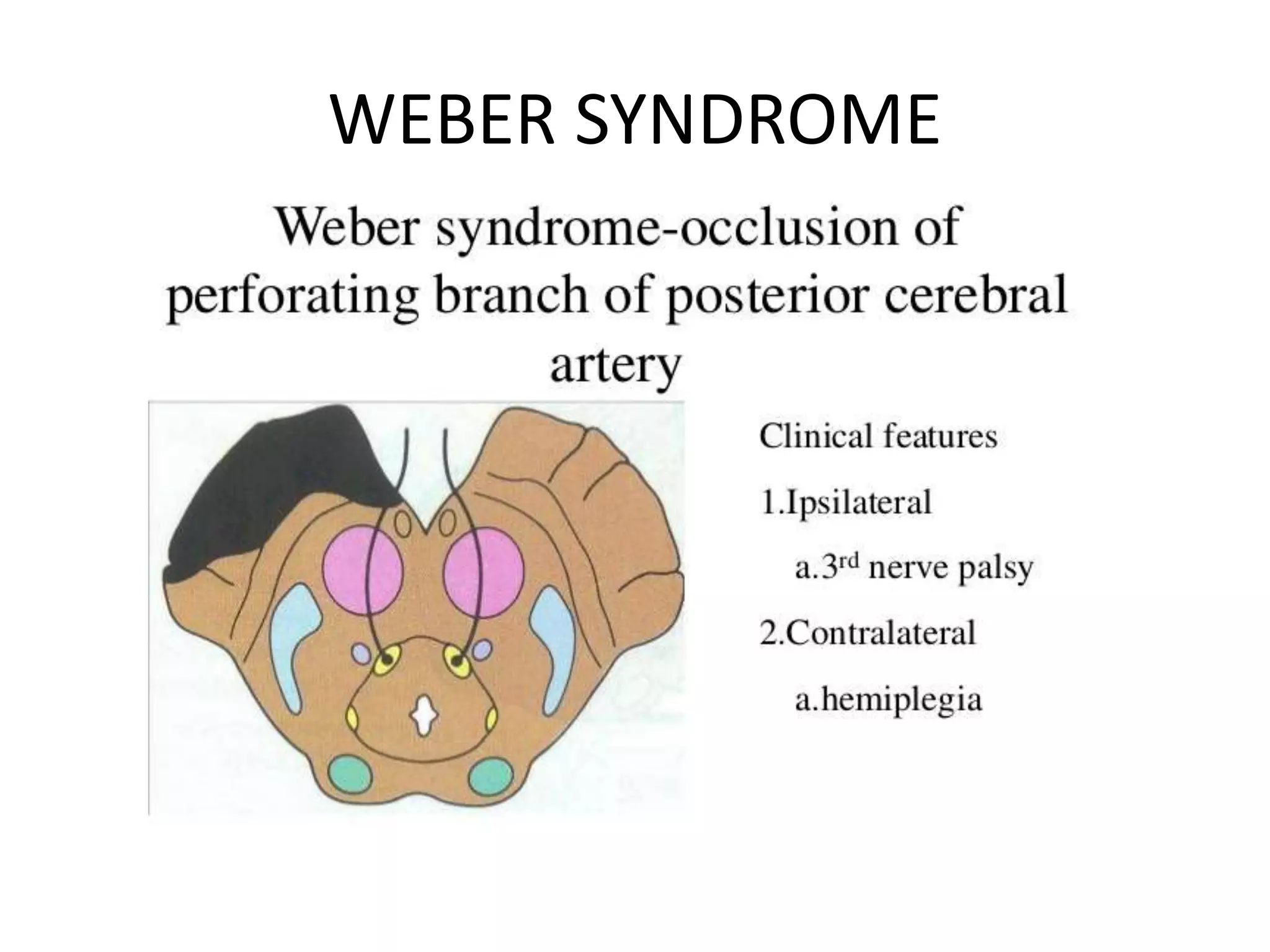 BRAINSTEM LESION INVOLVING 3rd 4th And 6th Cranial Nerve PPTX brainstem-lesion-involving-3rd-4th-and-6th-cranial-nerve-pptx
