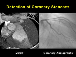 Detection of Coronary Stenoses
MDCT Coronary Angiography
 