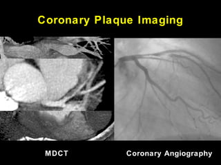 Coronary Plaque Imaging
MDCT Coronary Angiography
 