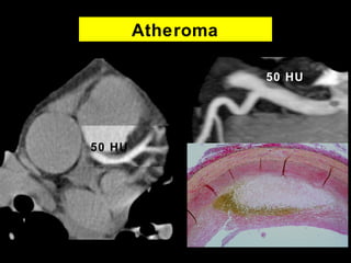 Atheroma
• 38 YOM
• Non specific complain
• Risk Factors
– Cholesterin
– Smoker
• No calcium
50 HU
50 HU
 
