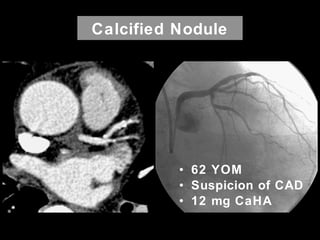 Calcified Nodule
• 62 YOM
• Suspicion of CAD
• 12 mg CaHA
 