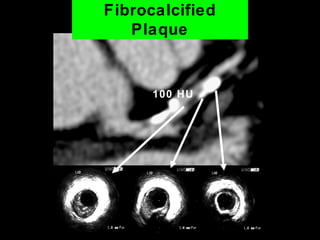 Fibrocalcified
Plaque
100 HU
 