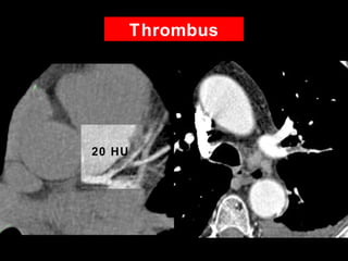 Thrombus
• 42 YOM
• Epigastric chest pain
• Risk Factors
– Hypertension
– Smoker
• No calcium
20 HU
 