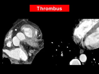Thrombus
 