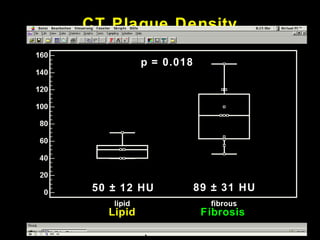 CT Plaque Density
Lipid Fibrose50 ± 12 HU 89 ± 31 HU
p = 0.018
Lipid Fibrosis
 