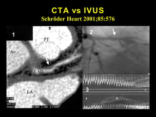 CTA vs IVUS
Schröder Heart 2001;85:576
 