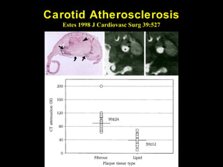 Carotid Atherosclerosis
Estes 1998 J Cardiovasc Surg 39:527
 