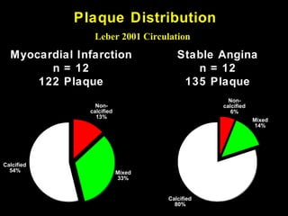 Plaque Distribution
Leber 2001 Circulation
Non-
calcified
13%
Mixed
33%
Calcified
54%
Myocardial Infarction
n = 12
122 Plaque
Stable Angina
n = 12
135 Plaque
Non-
calcified
6%
Mixed
14%
Calcified
80%
 
