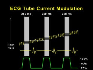 ECG Tube Current Modulation
Pitch
<0,4
250 ms 250 ms250 ms
100%
20%
mAs
 