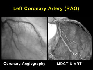 Left Coronary Artery (RAO)
Coronary Angiography MDCT & VRT
 