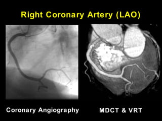 LAO 60Coronary Angiography MDCT & VRT
Right Coronary Artery (LAO)
 