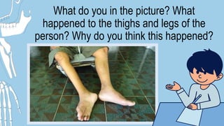 What do you in the picture? What
happened to the thighs and legs of the
person? Why do you think this happened?
 