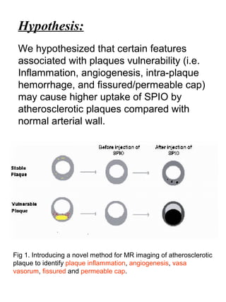 Hypothesis:
We hypothesized that certain features
associated with plaques vulnerability (i.e.
Inflammation, angiogenesis, intra-plaque
hemorrhage, and fissured/permeable cap)
may cause higher uptake of SPIO by
atherosclerotic plaques compared with
normal arterial wall.
Fig 1. Introducing a novel method for MR imaging of atherosclerotic
plaque to identify plaque inflammation, angiogenesis, vasa
vasorum, fissured and permeable cap.
 