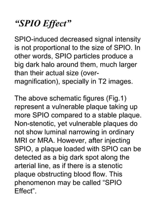 “SPIO Effect”
SPIO-induced decreased signal intensity
is not proportional to the size of SPIO. In
other words, SPIO particles produce a
big dark halo around them, much larger
than their actual size (over-
magnification), specially in T2 images.
The above schematic figures (Fig.1)
represent a vulnerable plaque taking up
more SPIO compared to a stable plaque.
Non-stenotic, yet vulnerable plaques do
not show luminal narrowing in ordinary
MRI or MRA. However, after injecting
SPIO, a plaque loaded with SPIO can be
detected as a big dark spot along the
arterial line, as if there is a stenotic
plaque obstructing blood flow. This
phenomenon may be called “SPIO
Effect”.
 