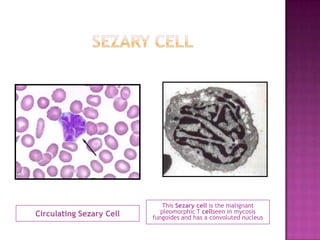 Circulating Sezary Cell
This Sezary cell is the malignant
pleomorphic T cellseen in mycosis
fungoides and has a convoluted nucleus
 