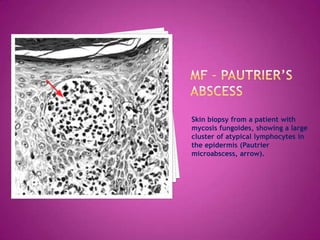 Skin biopsy from a patient with
mycosis fungoides, showing a large
cluster of atypical lymphocytes in
the epidermis (Pautrier
microabscess, arrow).
 