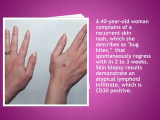 A 40-year-old woman
complains of a
recurrent skin
rash, which she
describes as "bug
bites." that
spontaneously regress
with in 2 to 3 weeks.
Skin biopsy results
demonstrate an
atypical lymphoid
infiltrate, which is
CD30 positive.
 