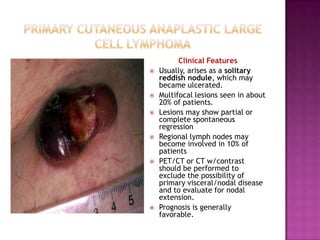 Clinical Features
 Usually, arises as a solitary
reddish nodule, which may
became ulcerated.
 Multifocal lesions seen in about
20% of patients.
 Lesions may show partial or
complete spontaneous
regression
 Regional lymph nodes may
become involved in 10% of
patients
 PET/CT or CT w/contrast
should be performed to
exclude the possibility of
primary visceral/nodal disease
and to evaluate for nodal
extension.
 Prognosis is generally
favorable.
 