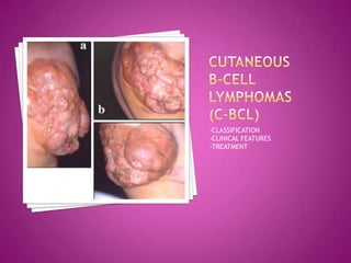 •CLASSIFICATION
•CLINICAL FEATURES
•TREATMENT
 