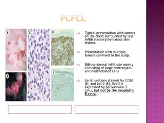 (A) Typical presentation with tumors
on the chest surrounded by less
infiltrated erythematous skin
lesions.
(B) Presentation with multiple
tumors confined to the scalp.
(C) Diffuse dermal infiltrate mainly
consisting of large centrocytes
and multilobated cells
(D) Serial sections stained for CD20
(D) and bcl-2 (E). Bcl-2 is
expressed by perivascular T
cells, but not by the neoplastic
B cells.).
 