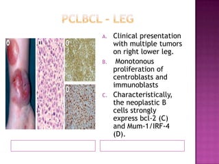 A. Clinical presentation
with multiple tumors
on right lower leg.
B. Monotonous
proliferation of
centroblasts and
immunoblasts
C. Characteristically,
the neoplastic B
cells strongly
express bcl-2 (C)
and Mum-1/IRF-4
(D).
 