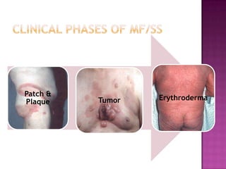Patch &
Plaque Tumor Erythroderma
 
