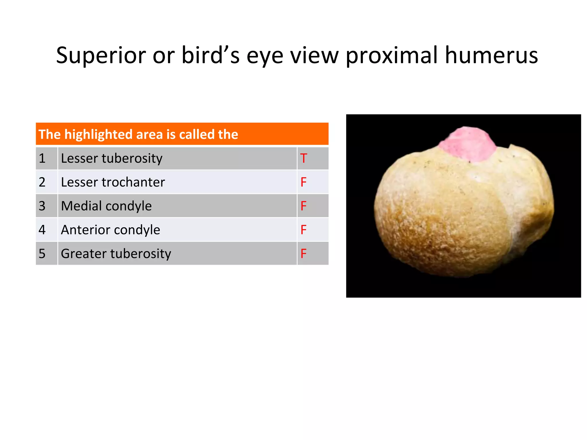 Superior or bird’s eye view proximal humerus
The highlighted area is called the
1 Lesser tuberosity T
2 Lesser trochanter F
3 Medial condyle F
4 Anterior condyle F
5 Greater tuberosity F
 