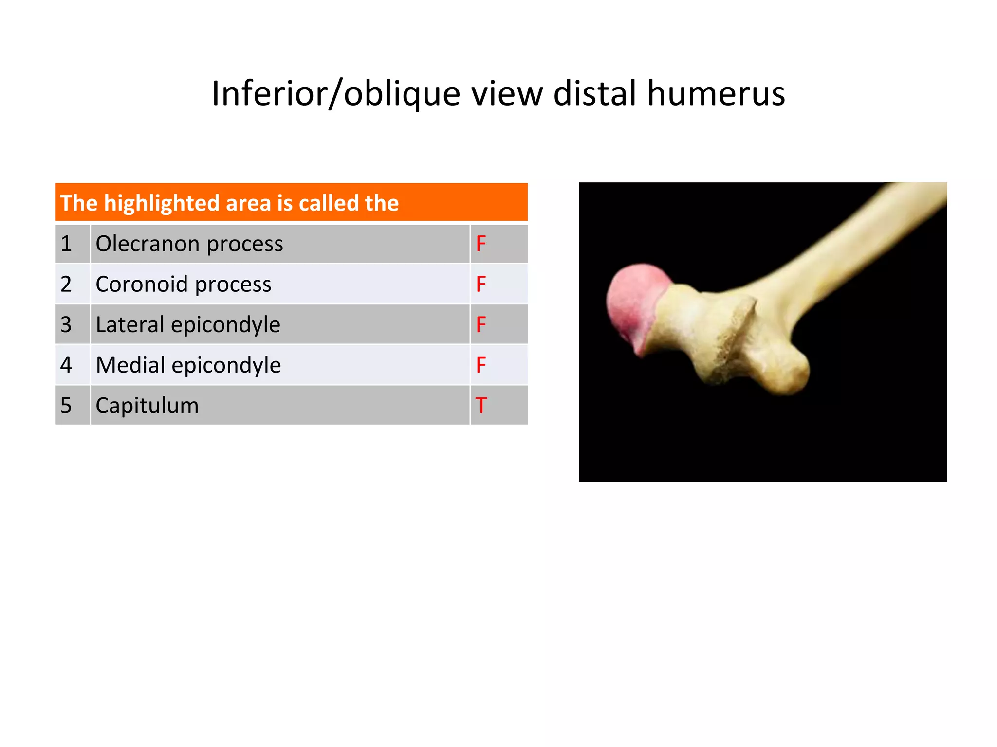 Inferior/oblique view distal humerus
The highlighted area is called the
1 Olecranon process F
2 Coronoid process F
3 Lateral epicondyle F
4 Medial epicondyle F
5 Capitulum T
 
