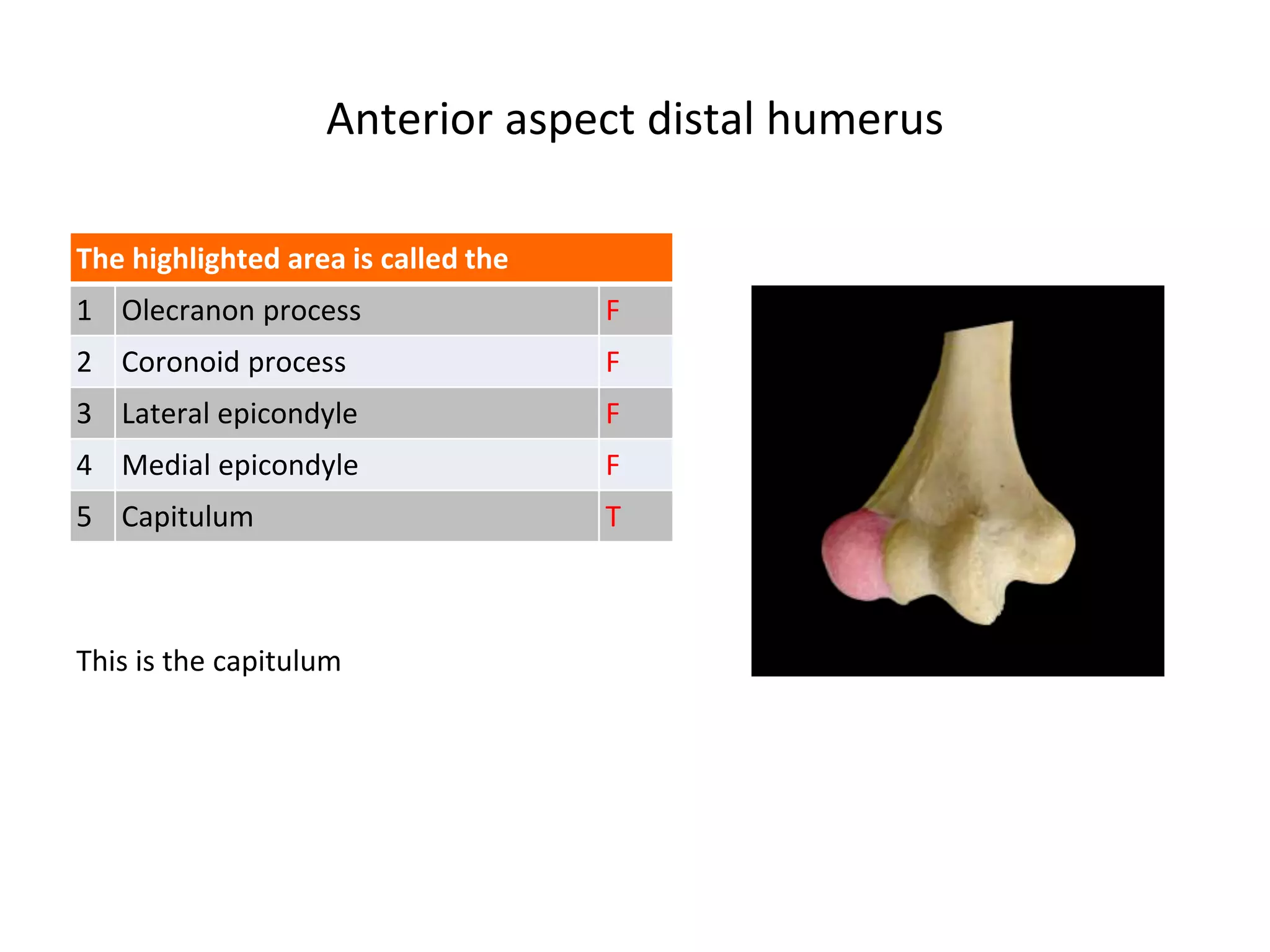 Anterior aspect distal humerus
The highlighted area is called the
1 Olecranon process F
2 Coronoid process F
3 Lateral epicondyle F
4 Medial epicondyle F
5 Capitulum T
This is the capitulum
 