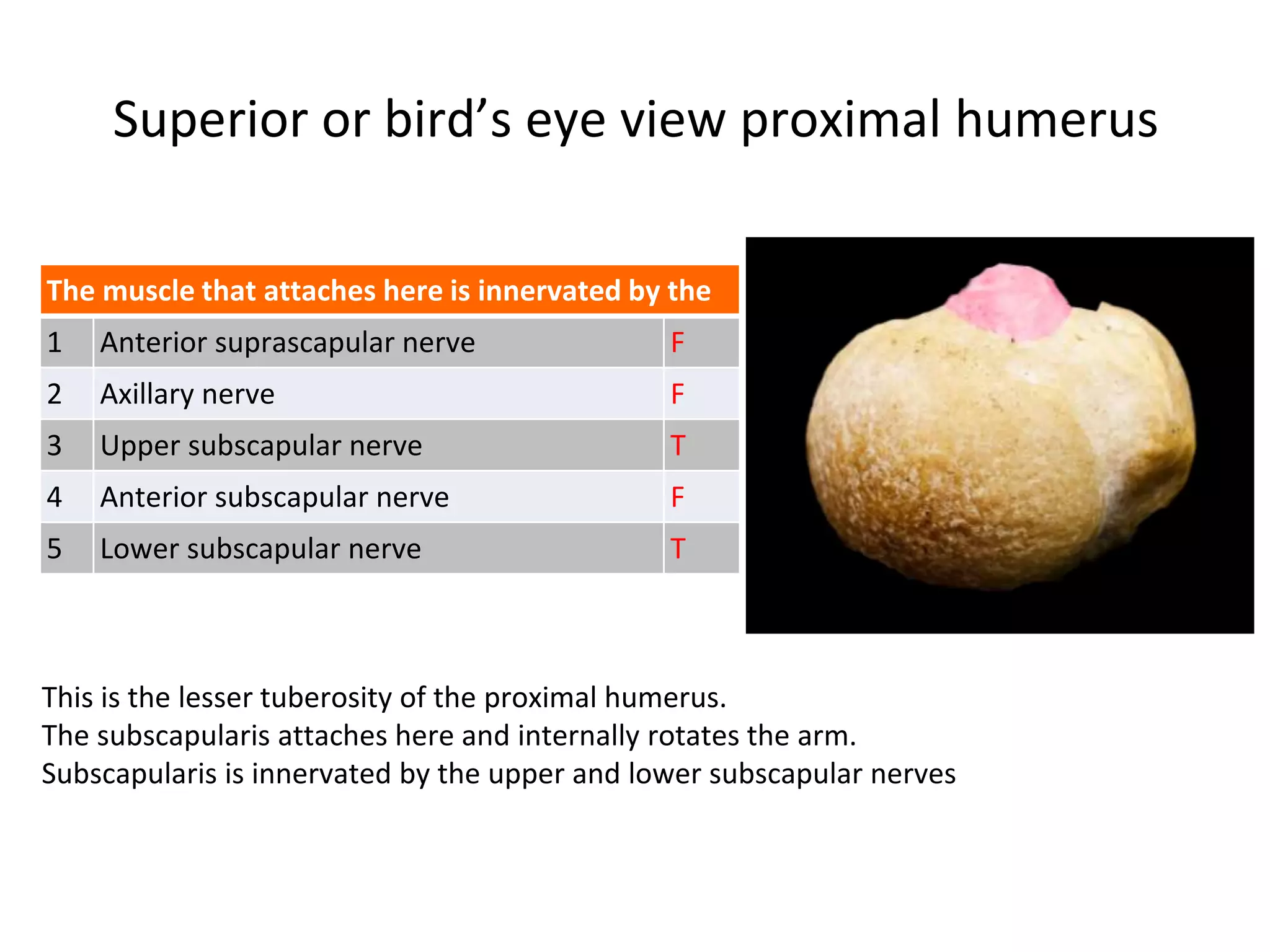 Superior or bird’s eye view proximal humerus
The muscle that attaches here is innervated by the
1 Anterior suprascapular nerve F
2 Axillary nerve F
3 Upper subscapular nerve T
4 Anterior subscapular nerve F
5 Lower subscapular nerve T
This is the lesser tuberosity of the proximal humerus.
The subscapularis attaches here and internally rotates the arm.
Subscapularis is innervated by the upper and lower subscapular nerves
 