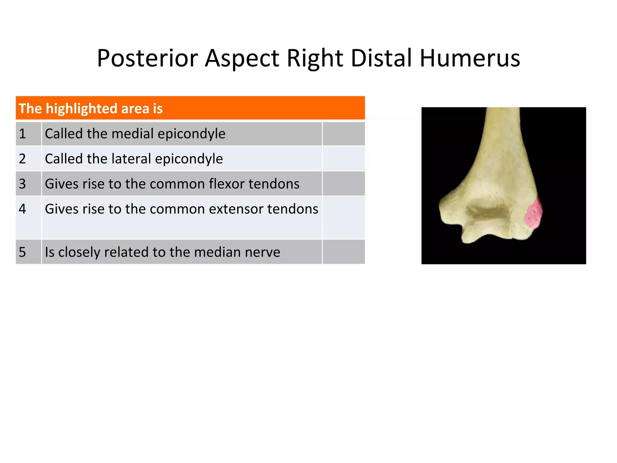 Posterior Aspect Right Distal Humerus
The highlighted area is
1 Called the medial epicondyle
2 Called the lateral epicondyle
3 Gives rise to the common flexor tendons
4 Gives rise to the common extensor tendons
5 Is closely related to the median nerve
 