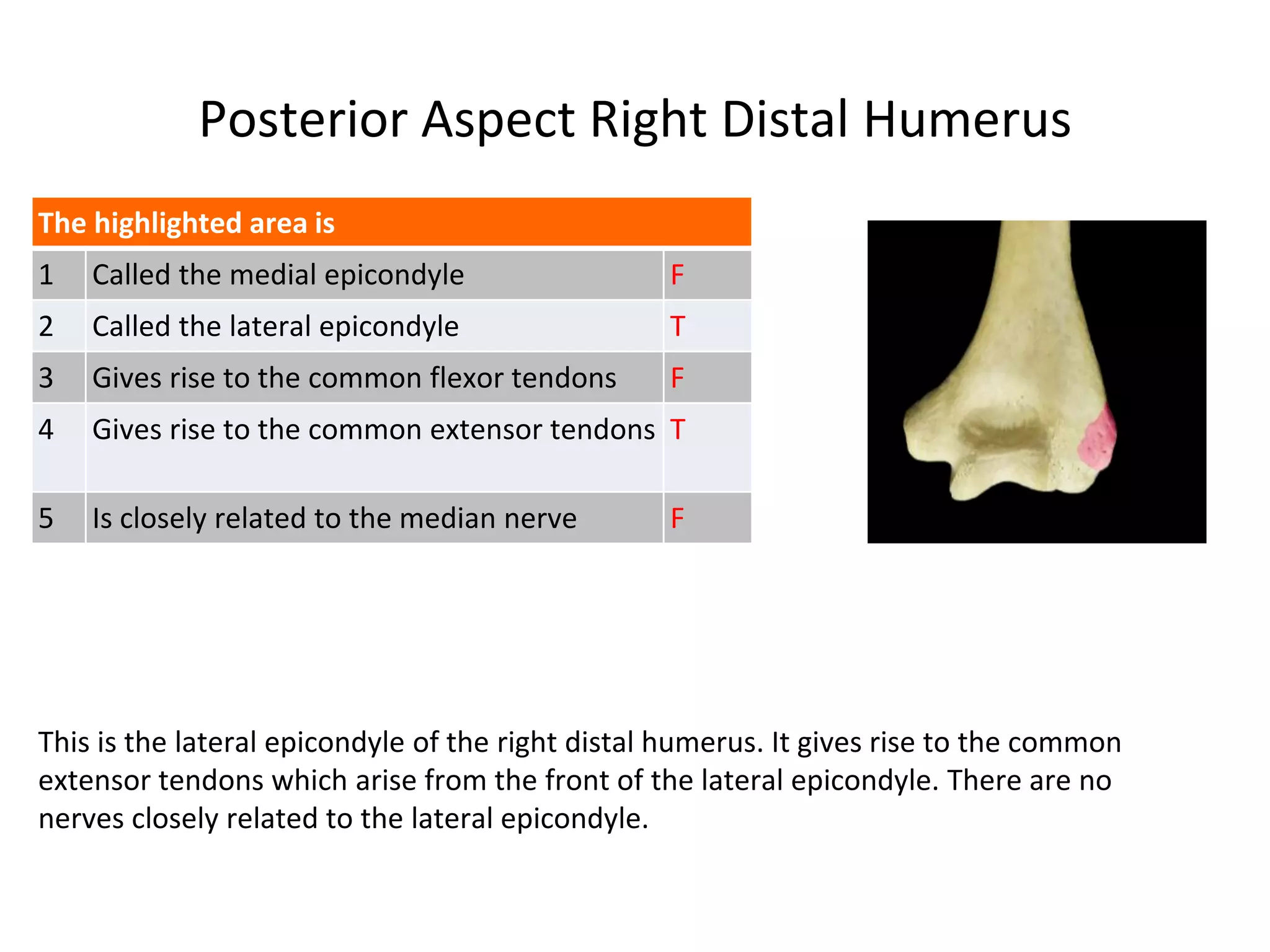 Posterior Aspect Right Distal Humerus
This is the lateral epicondyle of the right distal humerus. It gives rise to the common
extensor tendons which arise from the front of the lateral epicondyle. There are no
nerves closely related to the lateral epicondyle.
The highlighted area is
1 Called the medial epicondyle F
2 Called the lateral epicondyle T
3 Gives rise to the common flexor tendons F
4 Gives rise to the common extensor tendons T
5 Is closely related to the median nerve F
 
