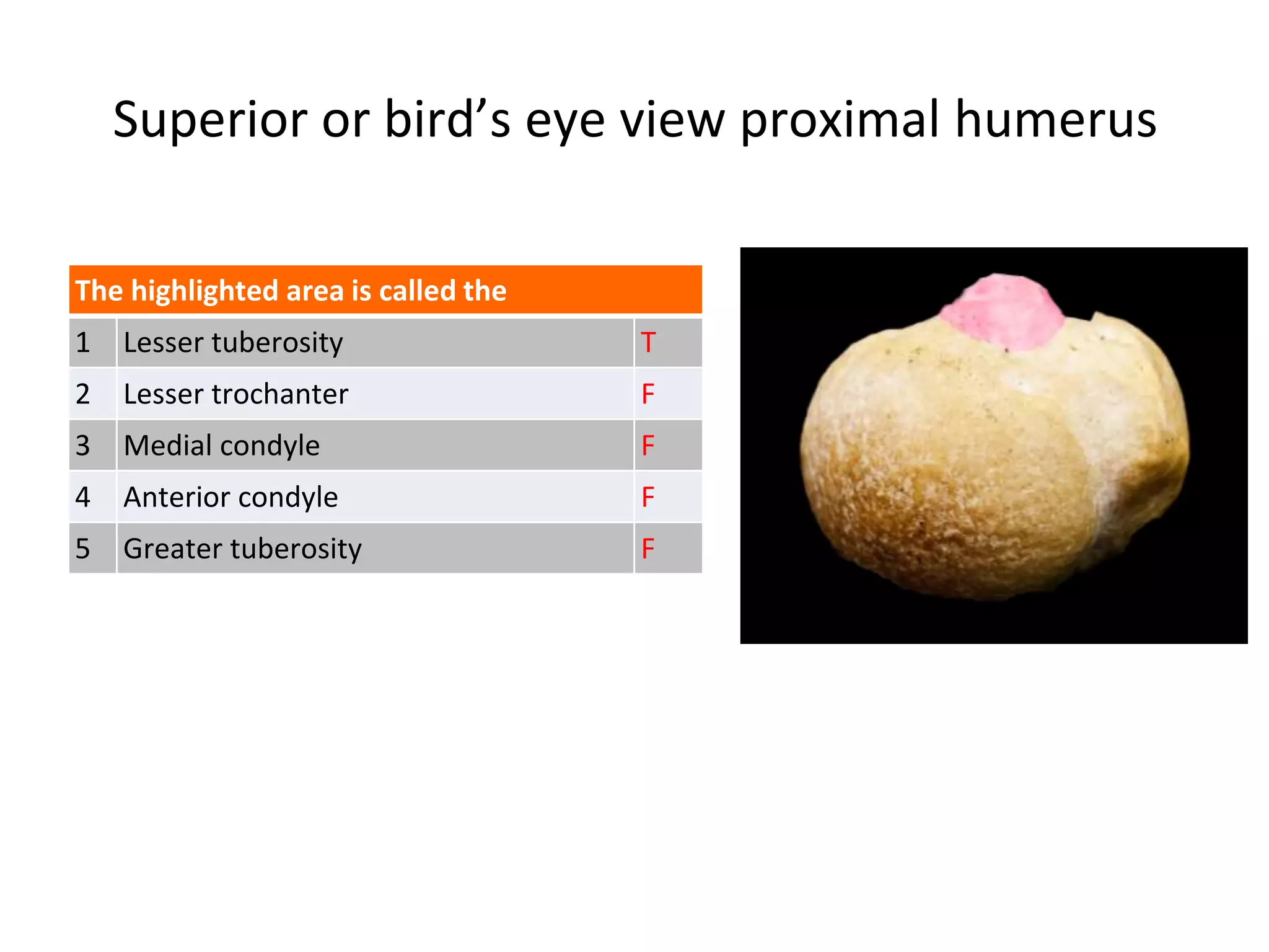 Superior or bird’s eye view proximal humerus
The highlighted area is called the
1 Lesser tuberosity T
2 Lesser trochanter F
3 Medial condyle F
4 Anterior condyle F
5 Greater tuberosity F
 