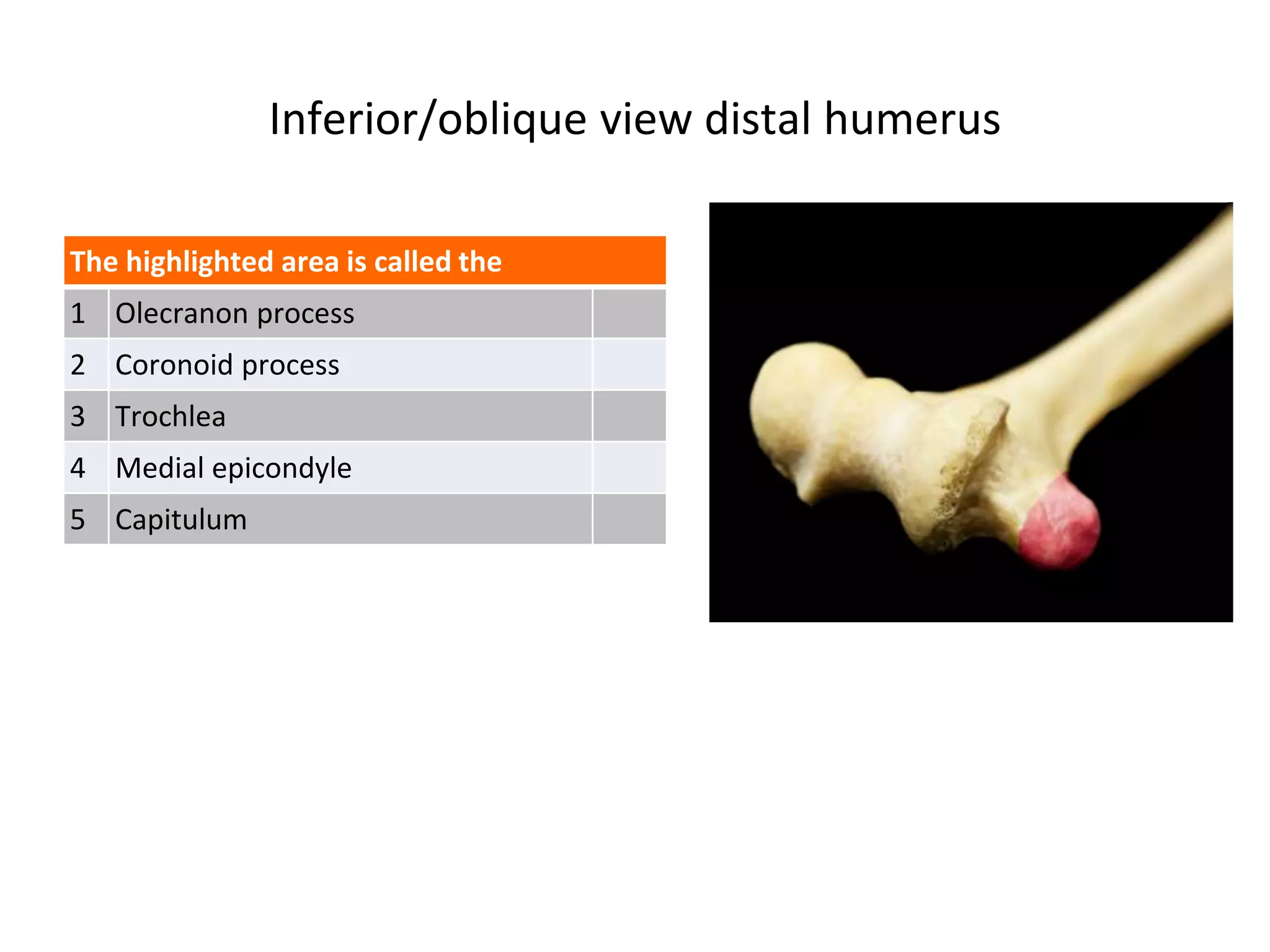 Inferior/oblique view distal humerus
The highlighted area is called the
1 Olecranon process
2 Coronoid process
3 Trochlea
4 Medial epicondyle
5 Capitulum
 