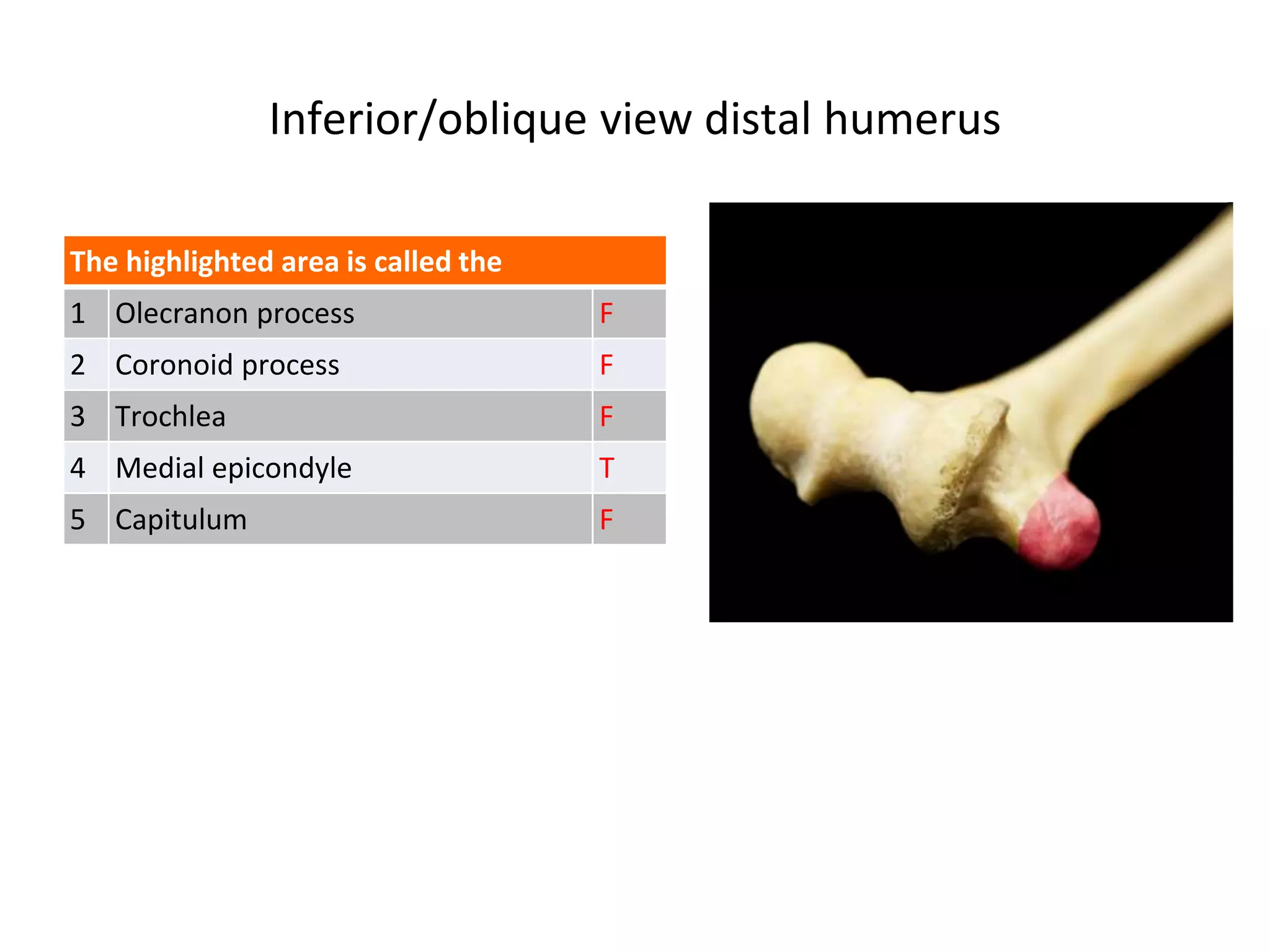 Inferior/oblique view distal humerus
The highlighted area is called the
1 Olecranon process F
2 Coronoid process F
3 Trochlea F
4 Medial epicondyle T
5 Capitulum F
 