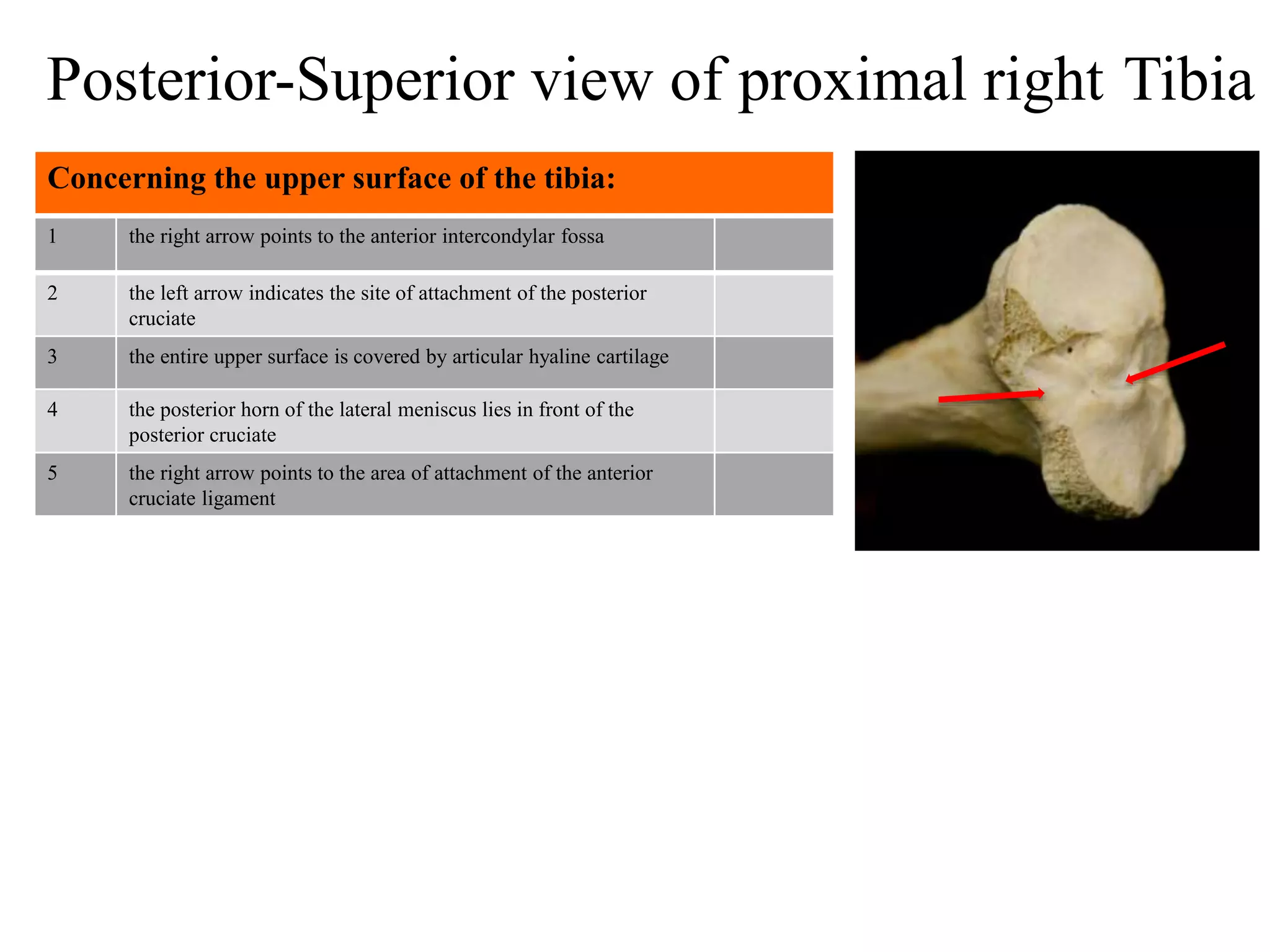 1 the right arrow points to the anterior intercondylar fossa
2 the left arrow indicates the site of attachment of the posterior
cruciate
3 the entire upper surface is covered by articular hyaline cartilage
4 the posterior horn of the lateral meniscus lies in front of the
posterior cruciate
5 the right arrow points to the area of attachment of the anterior
cruciate ligament
Concerning the upper surface of the tibia:
Posterior-Superior view of proximal right Tibia
 