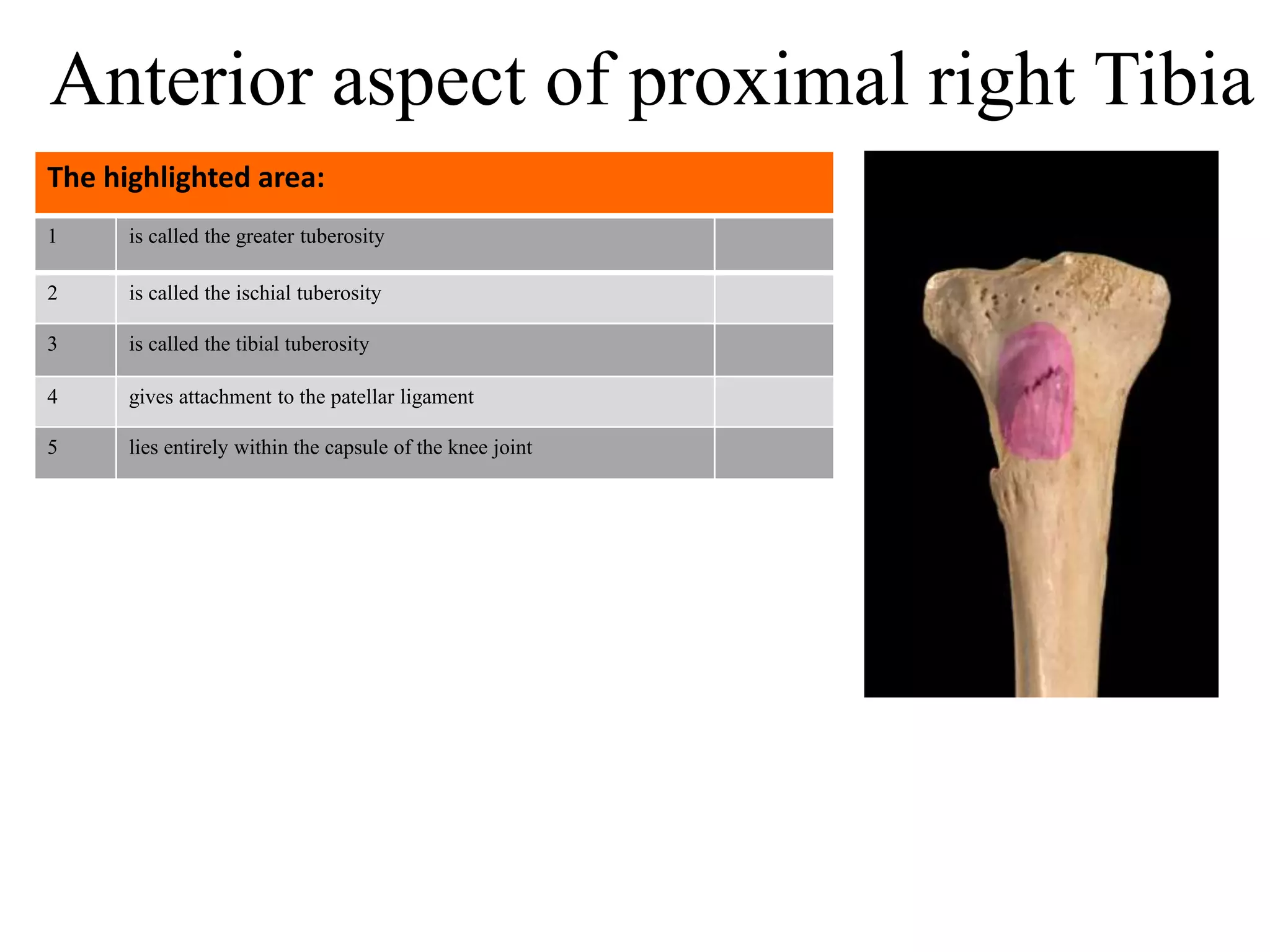 1 is called the greater tuberosity
2 is called the ischial tuberosity
3 is called the tibial tuberosity
4 gives attachment to the patellar ligament
5 lies entirely within the capsule of the knee joint
The highlighted area:
Anterior aspect of proximal right Tibia
 