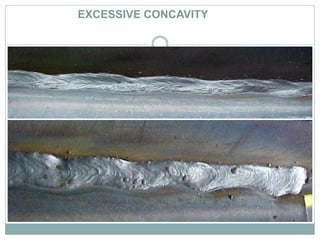 EXCESSIVE CONCAVITY
 