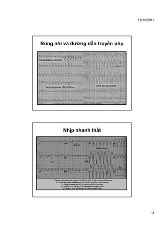13/10/2016
11
Rung nhĩ và đường dẫn truyền phụ
Nhịp nhanh thất
 