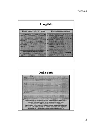 13/10/2016
12
Rung thất
Xoắn đỉnh
 
