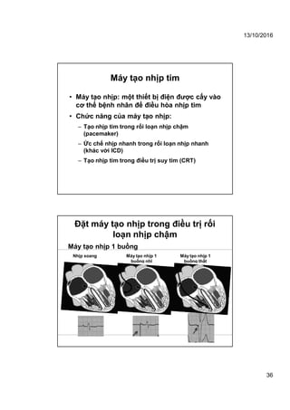 13/10/2016
36
Máy tạo nhịp tim
• Máy tạo nhịp: một thiết bị điện được cấy vào
cơ thể bệnh nhân để điều hòa nhịp tim
• Chức năng của máy tạo nhịp:
– Tạo nhịp tim trong rối loạn nhịp chậm
(pacemaker)
– Ức chế nhịp nhanh trong rối loạn nhịp nhanh
(khác với ICD)
– Tạo nhịp tim trong điều trị suy tim (CRT)
Đặt máy tạo nhịp trong điều trị rối
loạn nhịp chậm
Máy tạo nhịp 1 buồng
Nhịp xoang Máy tạo nhịp 1
buồng nhĩ
Máy tạo nhịp 1
buồng thất
 
